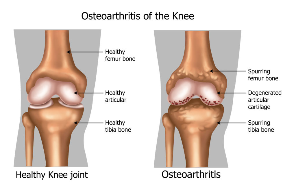 Image result for osteoarthritis of the knee images