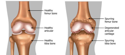 Gel Injections for Osteoarthritis in the Knee