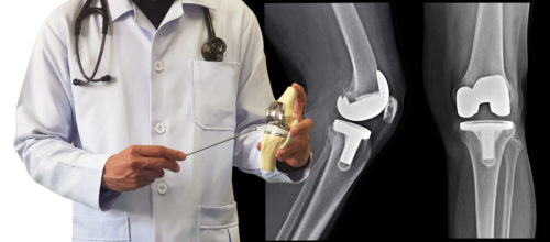 The Risk in Delaying Recommended Knee Replacement Surgery